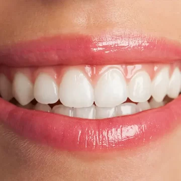 Things You Need To Know About Teeth Whitening Methods