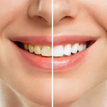 Which Teeth Whitening Method Should You Choose?