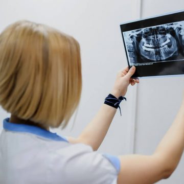 What are Dental X-Rays: Everything you need to know