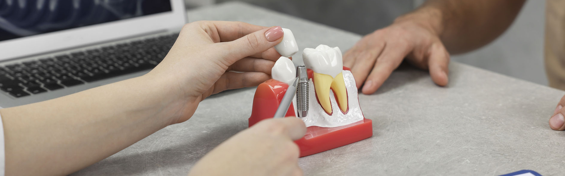 How Dental Implants Blend Perfectly