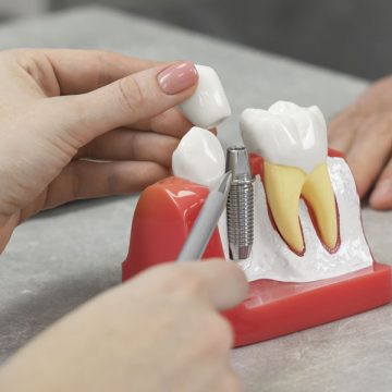 How Dental Implants Restore Function and Aesthetics: What You Should Know